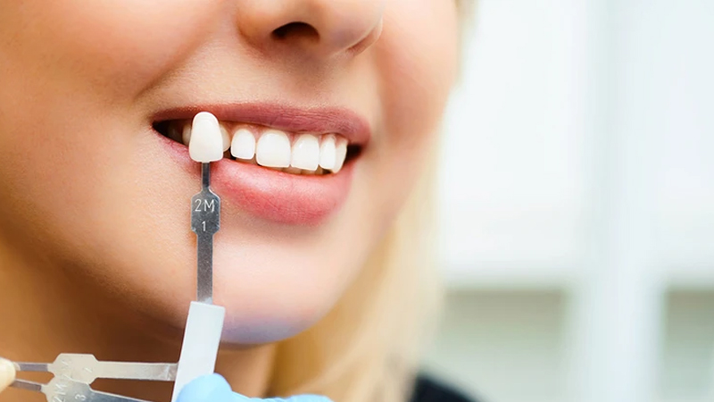 آیا میتوانیم در دوران بارداری از لمینت دندان استفاده کنیم؟