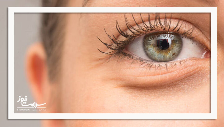 پف زیر چشم و روشهای درمان آن پف زیر چشم و روشهای درمان آن