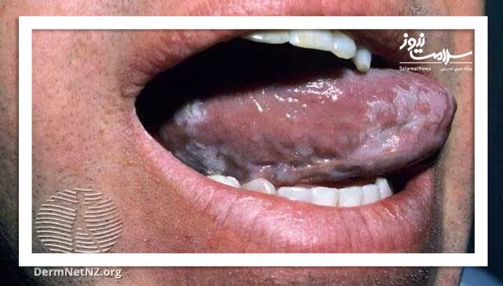 لکوپلاکی مودار دهان