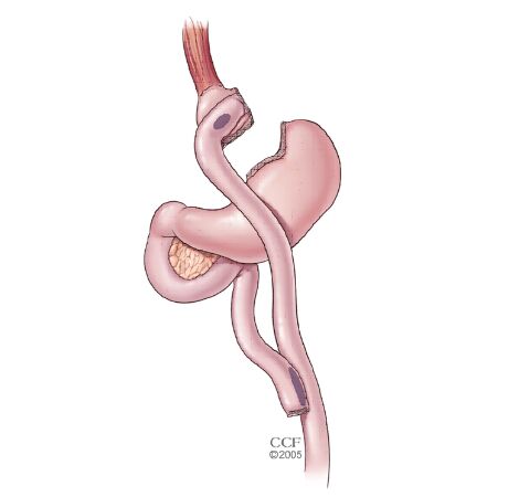 تغذیه بعد از بایپس معده؛ راهکاری برای سلامتی پایدار تغذیه بعد از بایپس معده؛ راهکاری برای سلامتی پایدار