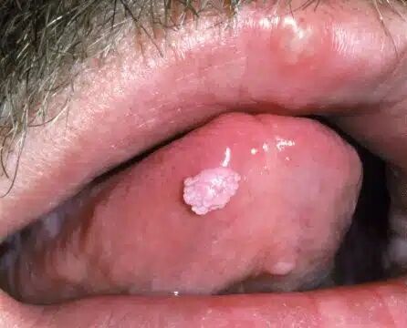 آیا زگیل تناسلی میتواند از طریق بزاق دهان منتقل شود؟ آیا زگیل تناسلی میتواند از طریق بزاق دهان منتقل شود؟