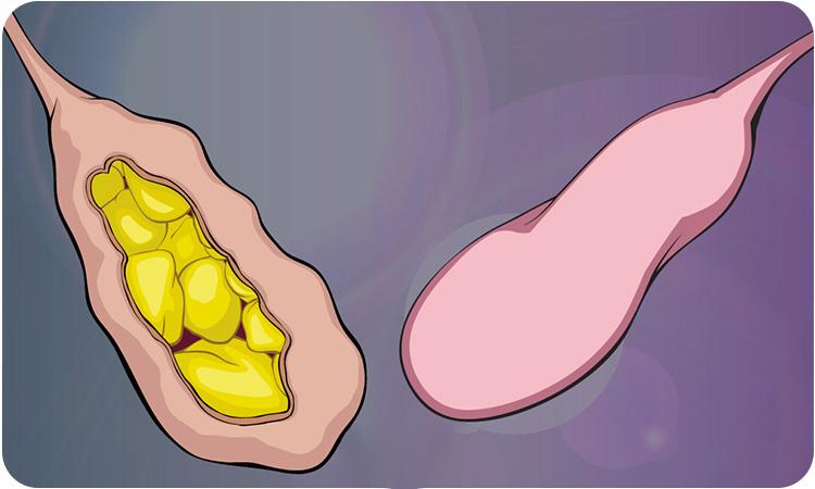 عمل کیسه صفرا با لیزر خطرناک است؟ مراقبتهای لازم