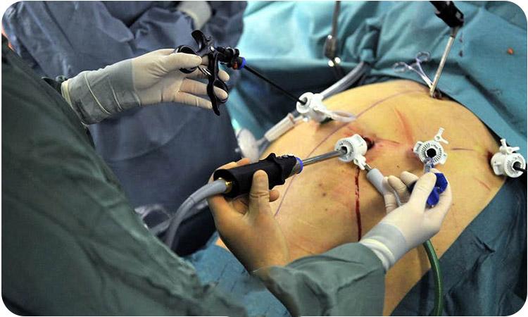 عمل کیسه صفرا با لیزر خطرناک است؟ مراقبتهای لازم