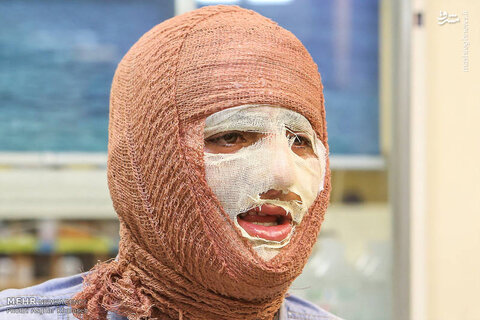 آیا بهبود کامل پس از سوختگی‌های عمیق امکان‌پذیر است؟