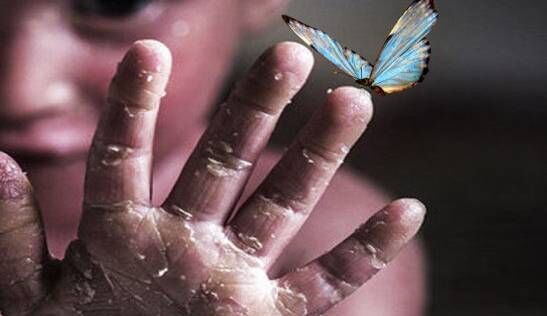 مقابله با تحریمها، ذخیرهسازی ۶ ماهه اقلام حیاتی برای بیماران پروانهای مقابله با تحریمها، ذخیرهسازی ۶ ماهه اقلام حیاتی برای بیماران پروانهای