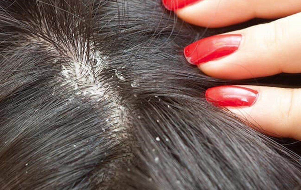 علائم، پیشگیری و درمان شپش سر؛ آشنایی کامل با این معضل شایع  علائم، پیشگیری و درمان شپش سر؛ آشنایی کامل با این معضل شایع