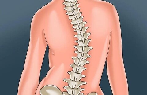 سه درصد مردم به انحراف ستون فقرات مبتلا هستند؛ تشخیص و درمان اسکولیوز