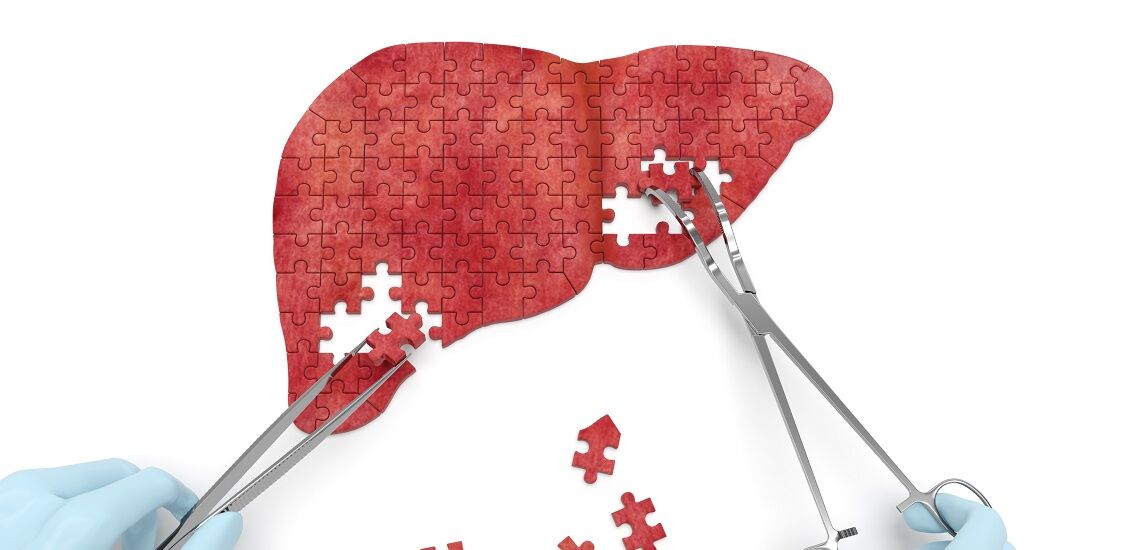 تغییر سبک زندگی؛ کلید پیشگیری از ابتلا به کبد چرب تغییر سبک زندگی؛ کلید پیشگیری از ابتلا به کبد چرب