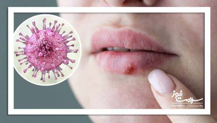 تبخال زدن احتمال آلزایمر را تقویت میکند تبخال زدن احتمال آلزایمر را تقویت میکند