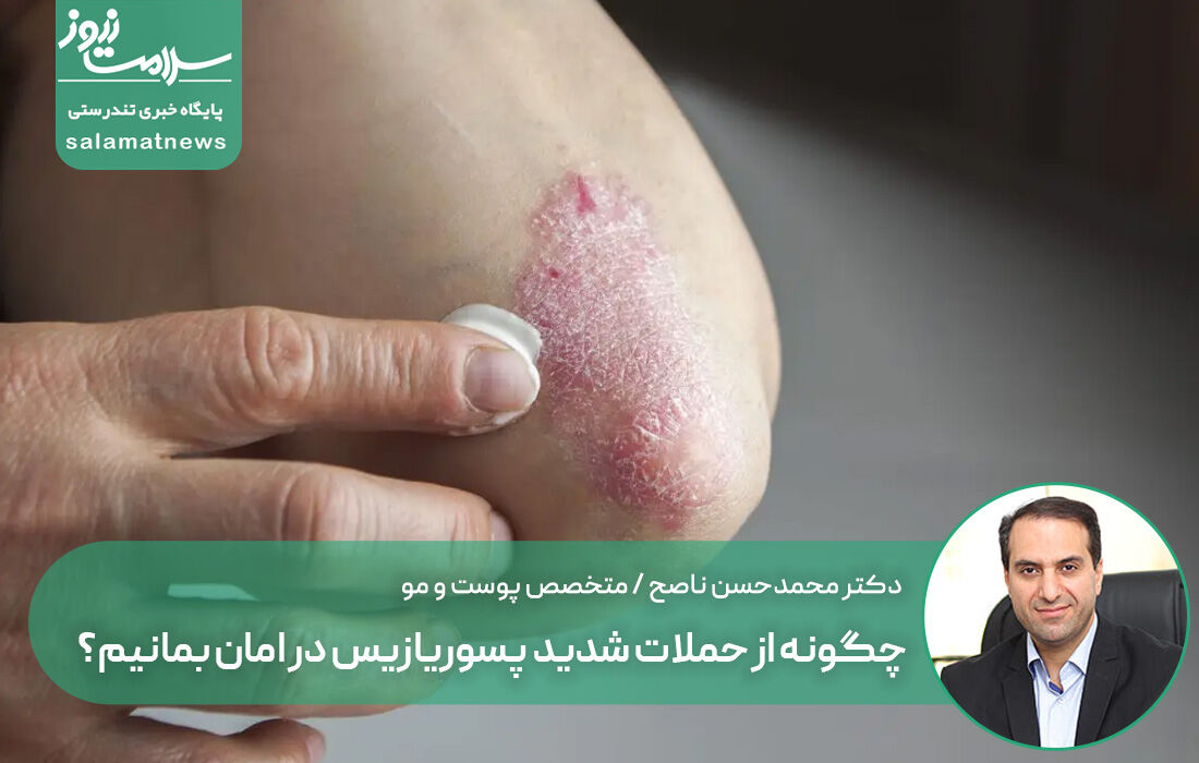 چگونه از حملات شدید پسوریازیس در امان بمانیم؟ چگونه از حملات شدید پسوریازیس در امان بمانیم؟
