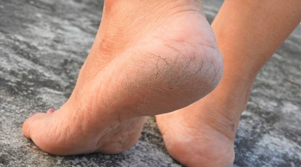 وقتی ترک پاشنه پا نشانهای از یک بیماری است وقتی ترک پاشنه پا نشانهای از یک بیماری است