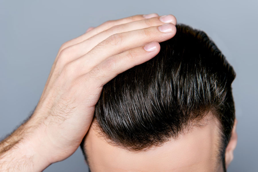 کاشت مو، سرمایهگذاری برای زیبایی همیشگی