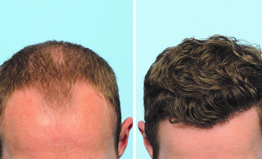 کاشت مو، سرمایهگذاری برای زیبایی همیشگی