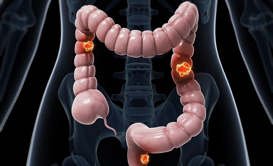 سرطان روده بعد از چند سال عود می‌کند؟
