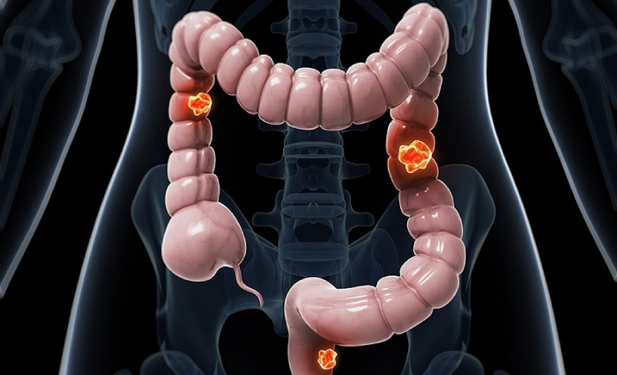 سرطان روده بعد از چند سال عود میکند؟