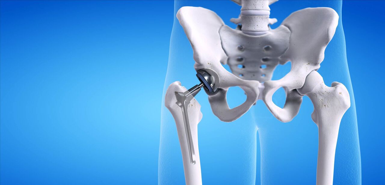 عمل تعویض مفصل لگن؛ راهکاری برای کاهش دردهای شدید و بهبود حرکت عمل تعویض مفصل لگن؛ راهکاری برای کاهش دردهای شدید و بهبود حرکت