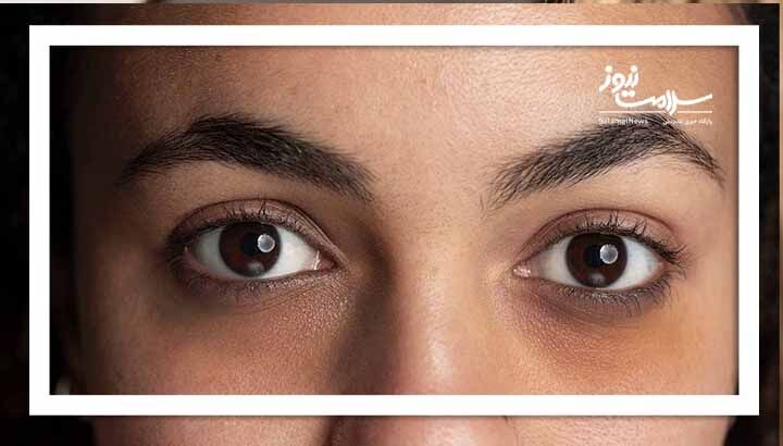 راهکارهای التیام تیرگی دور چشم راهکارهای التیام تیرگی دور چشم