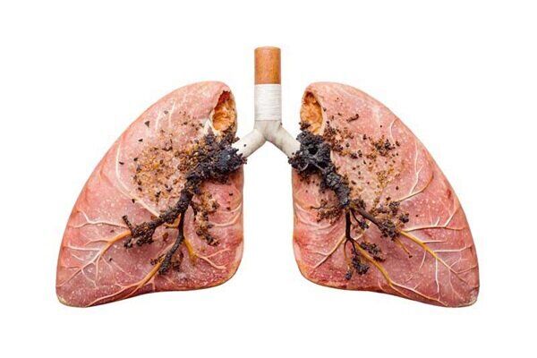 سیگار قاتل خاموش ریهها؛ سرطان ریه در زنان رو به افزایش است