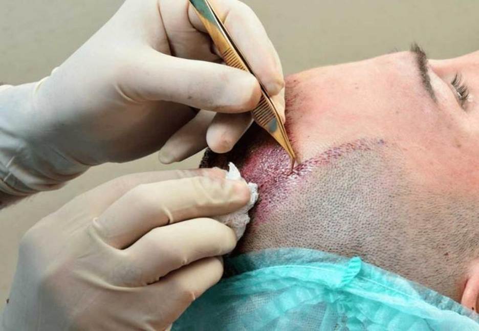 کاشت مو در چند جلسه انجام میشود