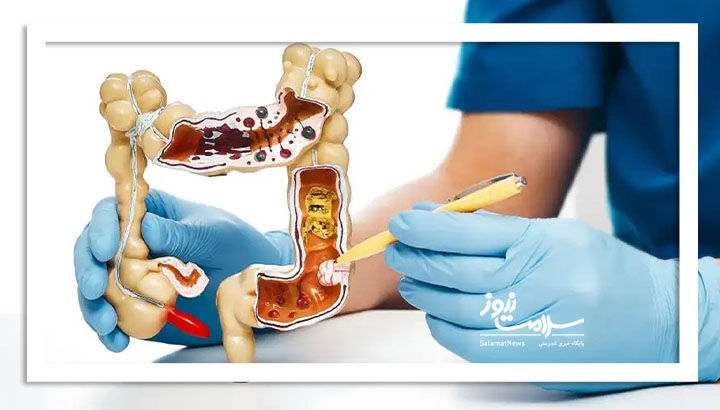 رابطه متقابل تغذیه و بروز سرطان‌های دستگاه گوارش