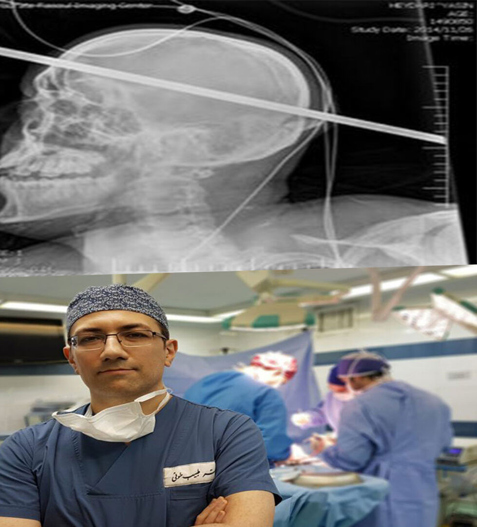 جراحی کم نظیر دکتر علیرضا طبیب خوئی برای خروج میلگرد جراحی کم نظیر دکتر علیرضا طبیب خوئی برای خروج میلگرد