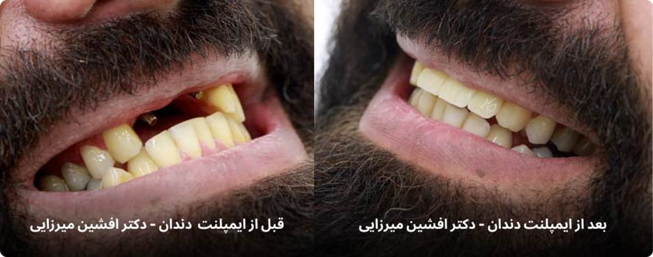 تجربه واقعی یک بیمار | بازگشت لبخند و اعتمادبهنفس با ایمپلنت دندان دیجیتال