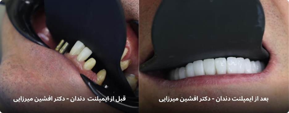 تجربه واقعی یک بیمار | بازگشت لبخند و اعتمادبهنفس با ایمپلنت دندان دیجیتال