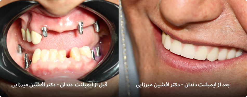 تجربه واقعی یک بیمار | بازگشت لبخند و اعتمادبهنفس با ایمپلنت دندان دیجیتال