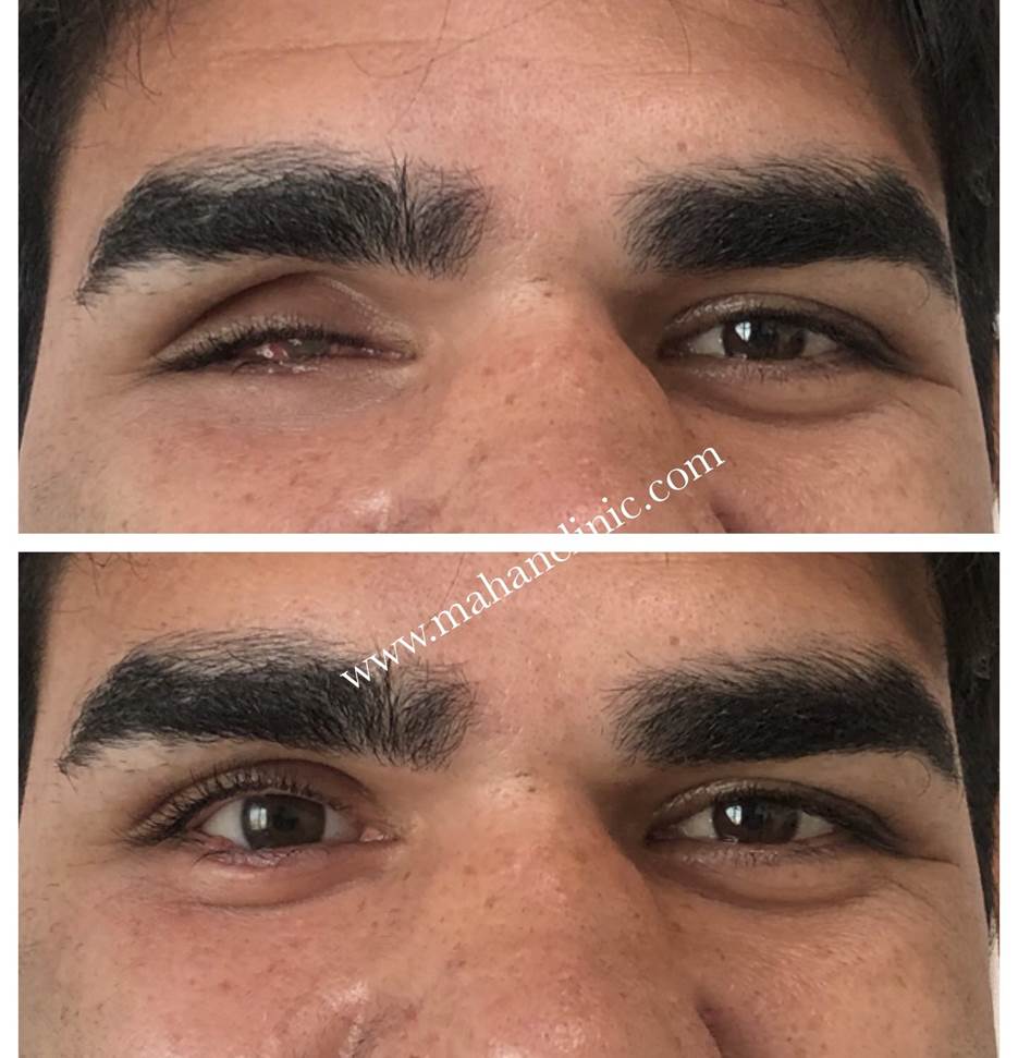 بازسازی چهره و پیشگیری از عوارض پس از تخلیه چشم با پروتزهای چشمی پیشرفته