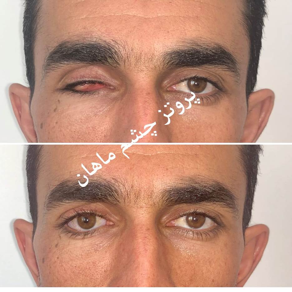 بازسازی چهره و پیشگیری از عوارض پس از تخلیه چشم با پروتزهای چشمی پیشرفته