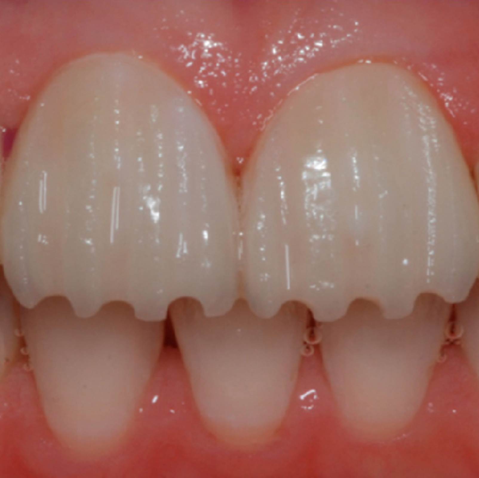 تراشیدن دندان برای لمینت واجب است؟