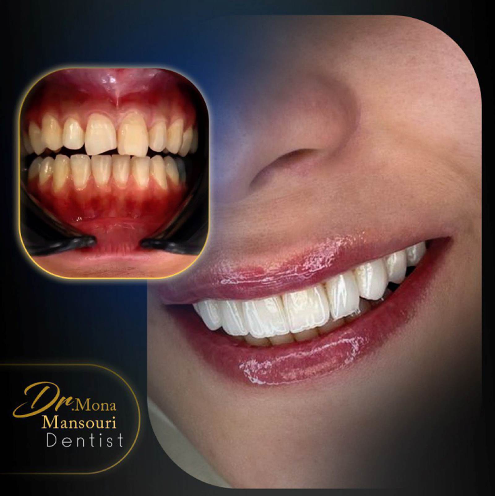 تراشیدن دندان برای لمینت واجب است؟