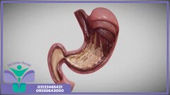 عوارض اسلیو معده؛ آنچه باید قبل از جراحی بدانید