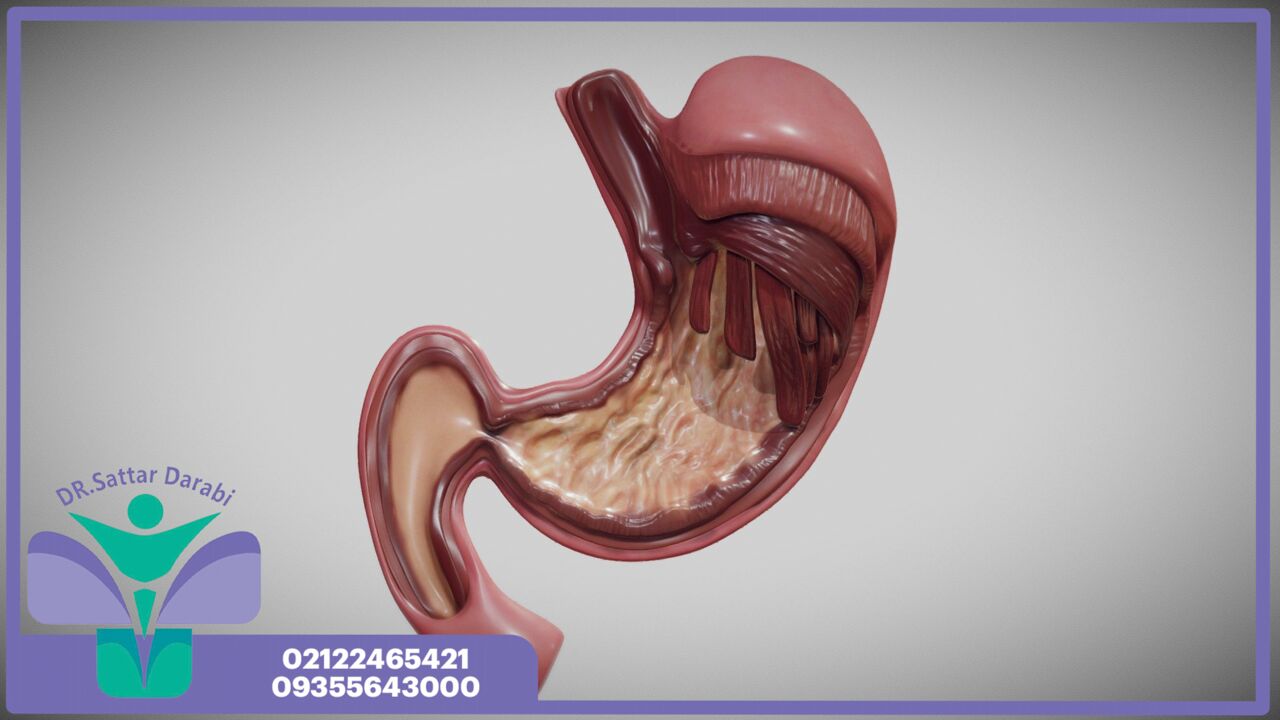 عوارض اسلیو معده؛ آنچه باید قبل از جراحی بدانید