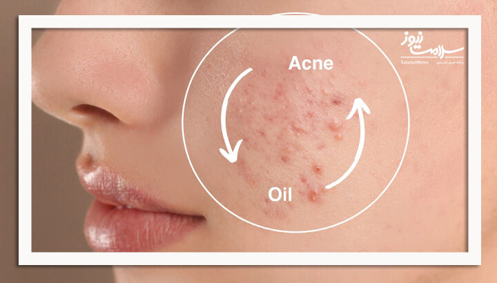 8 باور غلط درباره پوست چرب 8 باور غلط درباره پوست چرب