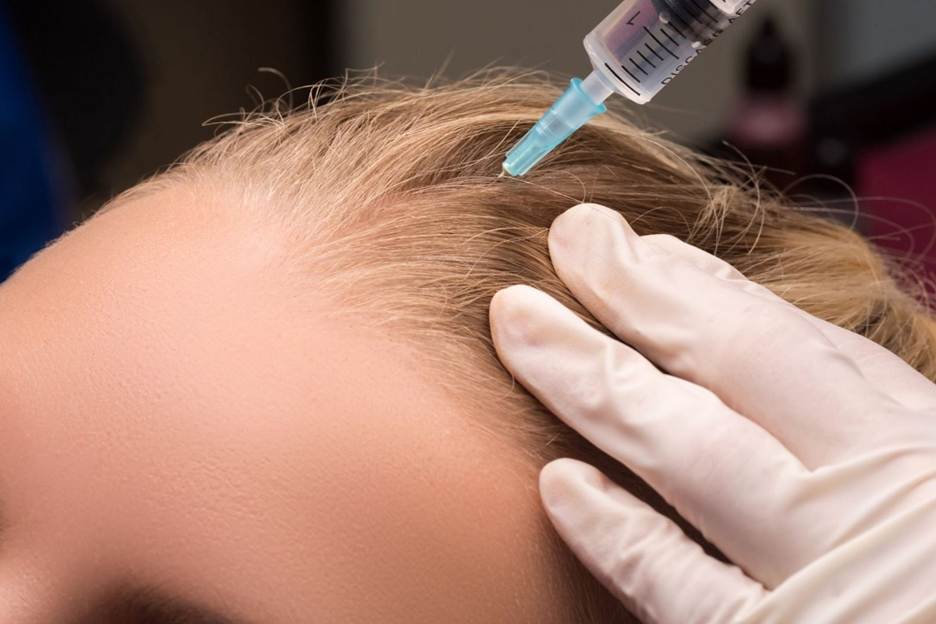 مزوتراپی مو چگونه انجام می شود؟