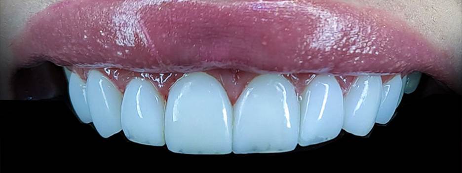 دکتر کامپوزیت دندان در شیراز | خدمات + لیست قیمت 1404