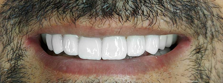 دکتر کامپوزیت دندان در شیراز | خدمات + لیست قیمت 1404