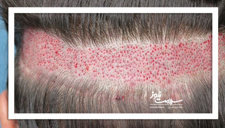 چرا نتیجه کاشت  برای همه مو  راضی کننده نیست