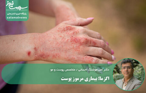 اگزما؛ بیماری مرموز پوست