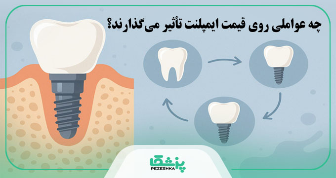 قیمت ایمپلنت دندان در سال 1404 + جدول هزینه انواع برندها【سال1404】