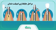 قیمت ایمپلنت دندان در سال 1404 + جدول هزینه انواع برندها【سال1404】