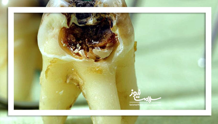 تبلیغات محصولات ضد پوسیدگی دندان تا چه میزان واقعی است؟ تبلیغات محصولات ضد پوسیدگی دندان تا چه میزان واقعی است؟