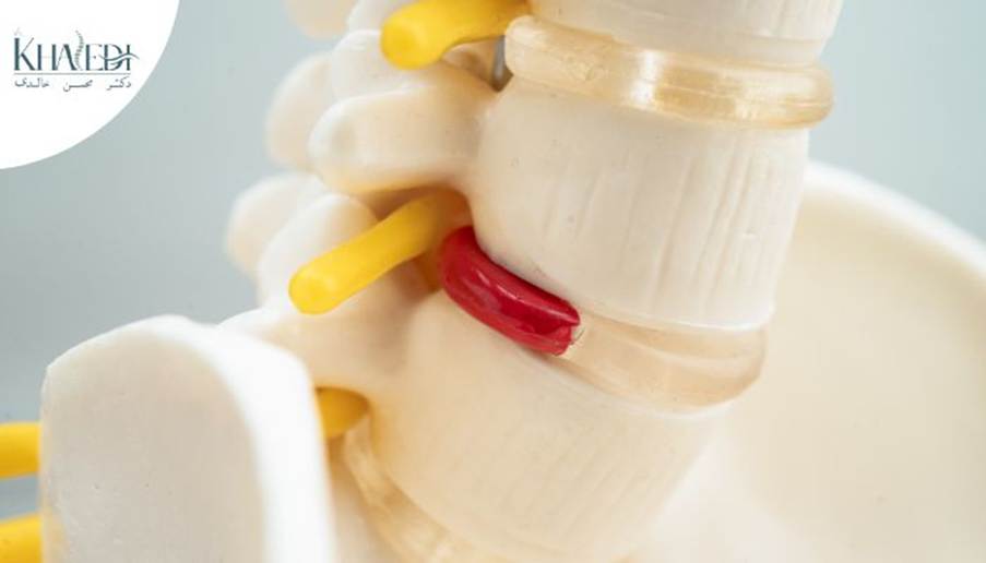 روش های سریع و موثر برای اصلاح بیرون زدگی دیسک ستون فقرات