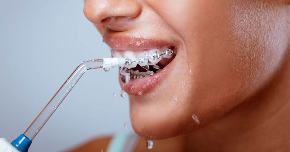 مراقبت های دوران ارتودنسی دندان