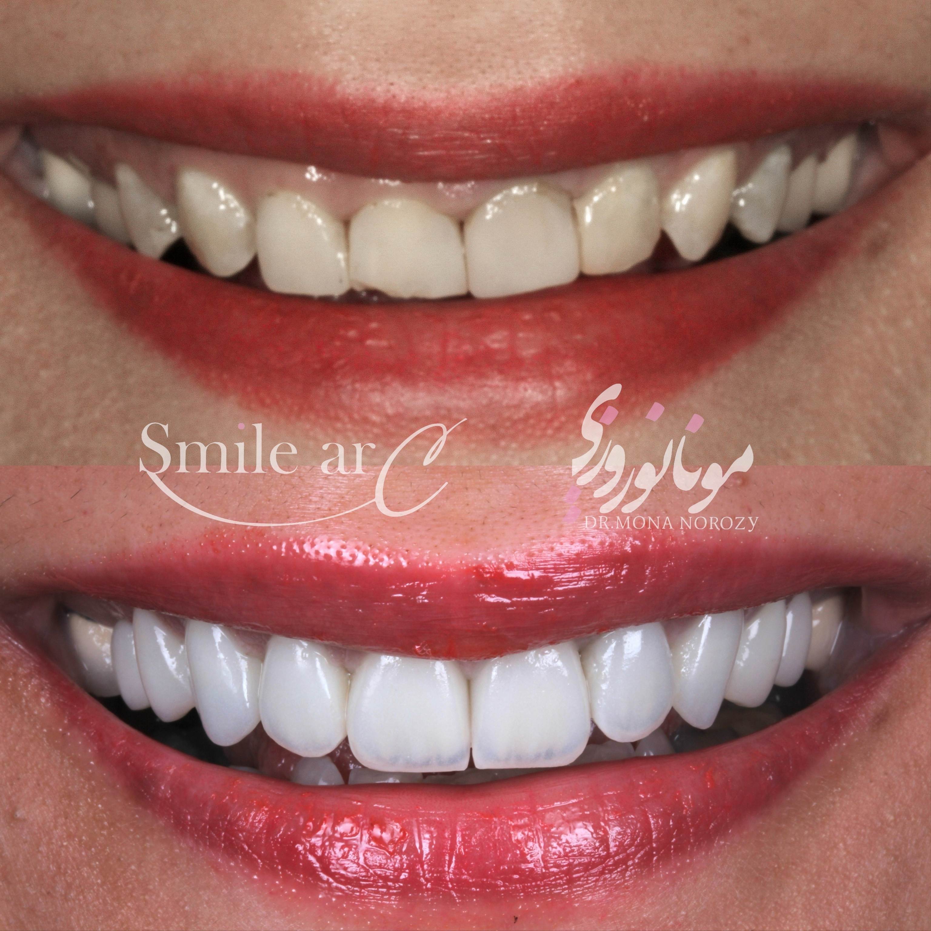 کامپوزیت دندان در کدام کشور مناسب است؟ راهنمای کامل 1404