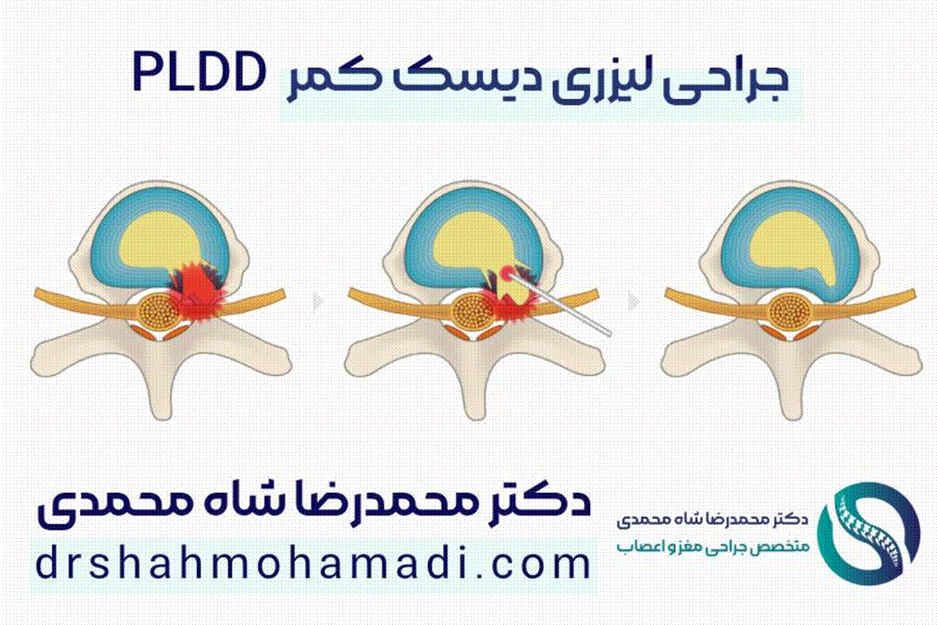 جراحی دیسک کمر با لیزر - دکتر محمدرضا شاه محمدی