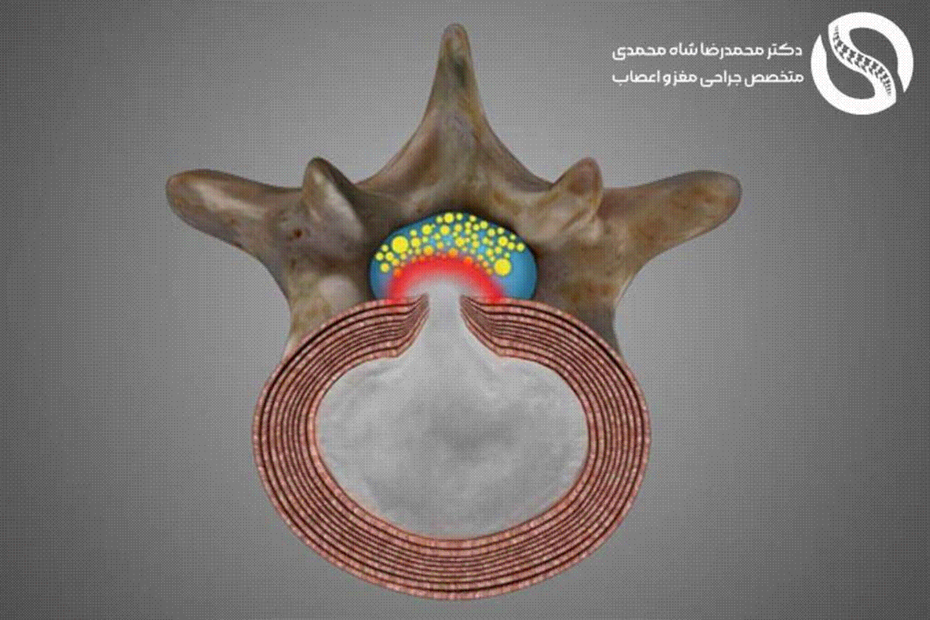دیسک کمر چیست - دکتر محمد رضا شاه محمدی