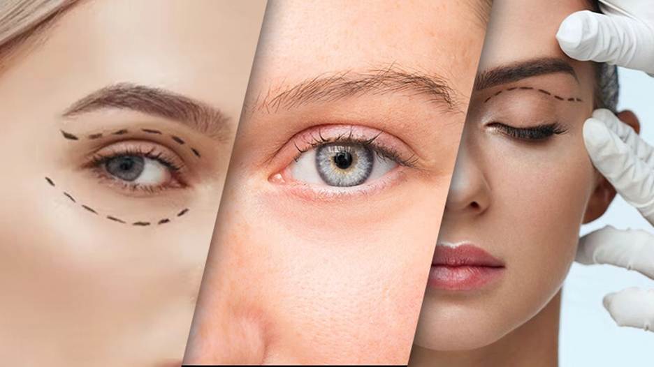 همه چیز در مورد عمل زیبایی پلک (بلفاروپلاستی)؛ چطور چشمها رو جوانتر میکنه؟