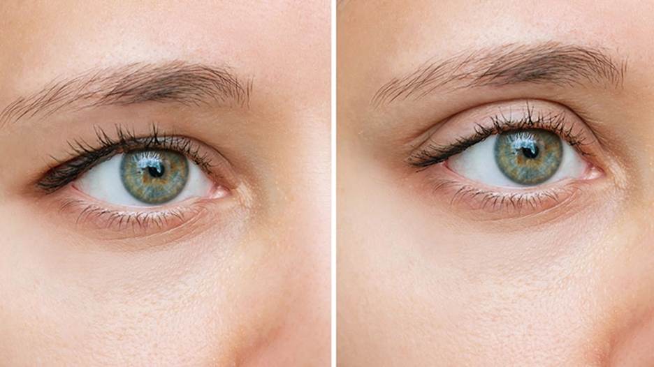 همه چیز در مورد عمل زیبایی پلک (بلفاروپلاستی)؛ چطور چشمها رو جوانتر میکنه؟